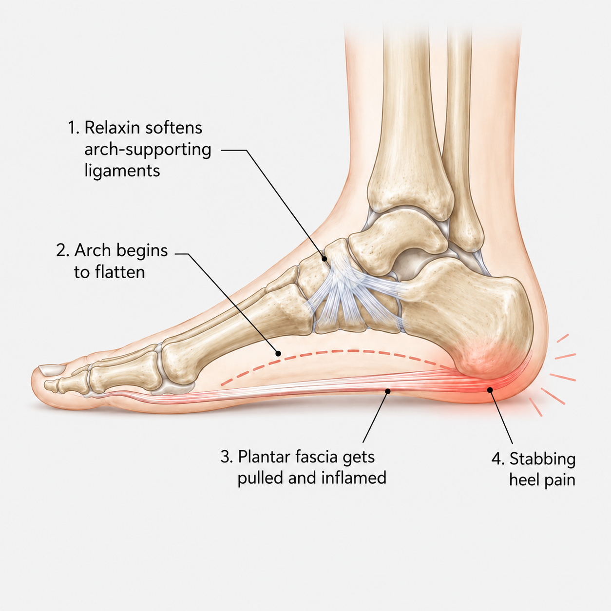 Diagram of the foot showing how relaxin softens arch ligaments, the arch flattening, the plantar fascia getting pulled, and resulting heel pain